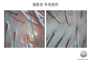 여성두피 염증성두피 3개월관리후기 