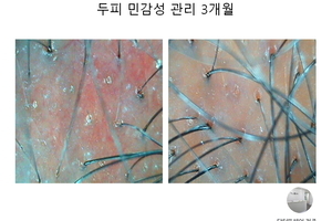 두피민감성 3개월 관리후기